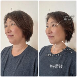 小顔矯正ビフォアアフター