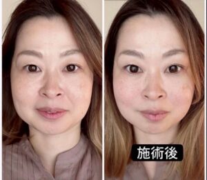 小顔矯正施術ビフォアアフター